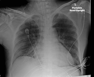 Lahoud Lungs All Clear. Day Two.
